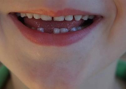 男子30多岁牙齿全掉光？孩子一颗“乳牙”或是救“牙”新希望！